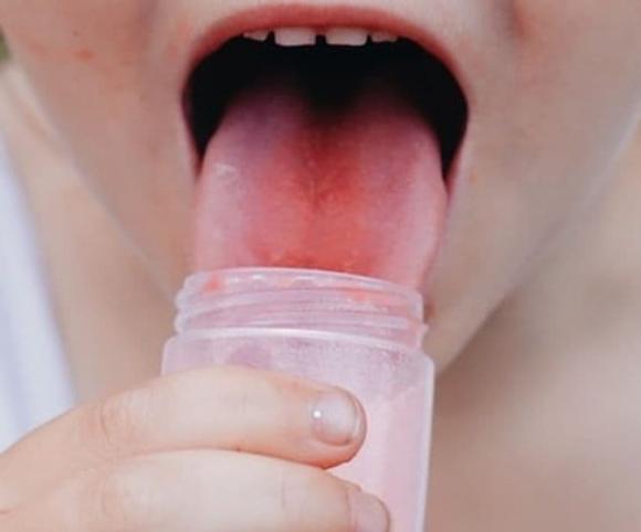 bỏng lưỡi, bỏng rát lưỡi, chữa lành vết bỏng rát lưỡi,