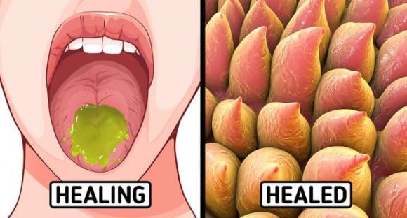 bỏng lưỡi, bỏng rát lưỡi, chữa lành vết bỏng rát lưỡi,