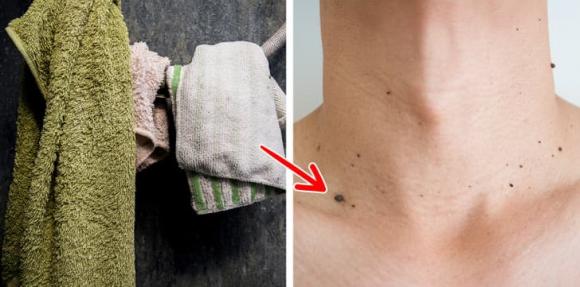 mụn cóc, ngăn ngừa mụn cóc, sức khỏe 