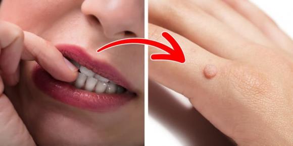 mụn cóc, ngăn ngừa mụn cóc, sức khỏe 