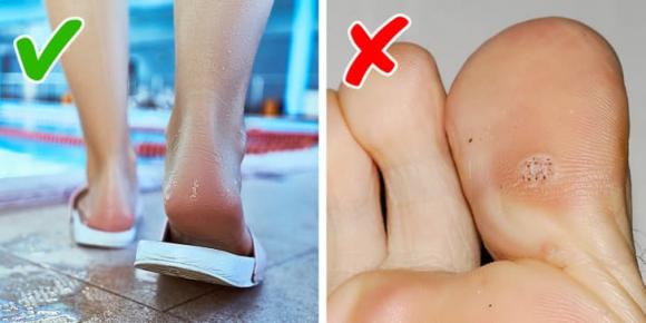 mụn cóc, ngăn ngừa mụn cóc, sức khỏe 