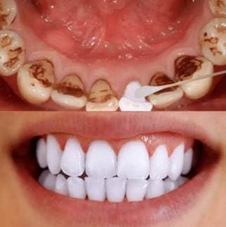 vệ sinh răng miệng, răng ố vàng, mẹo hay