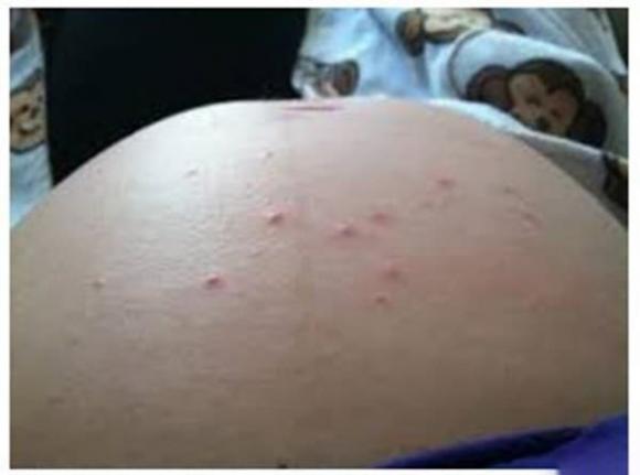 mọc mụn, mụn
