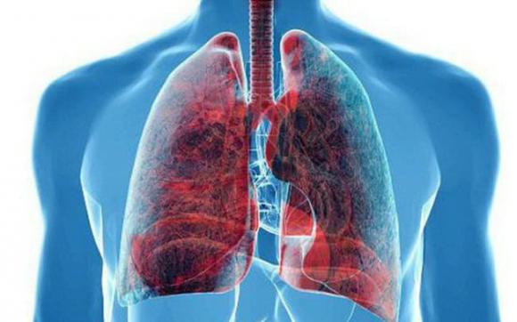 ung thư phổi, ung thư, dấu hiệu của ung thư phổi