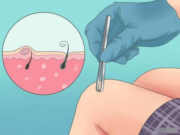 lông, lông mọc ngược, bệnh ngoài da