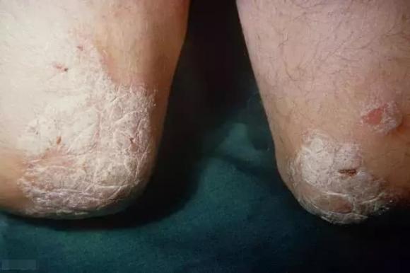 bệnh vảy nển, bệnh ngoài da