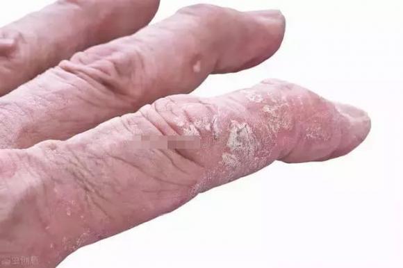bệnh vảy nển, bệnh ngoài da