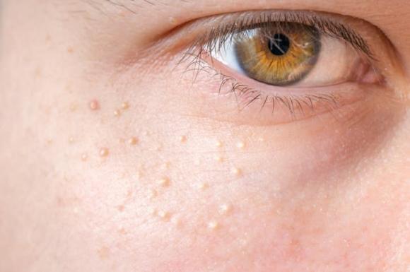 mụn thịt, cách điều trị mụn thịt, làm đẹp da