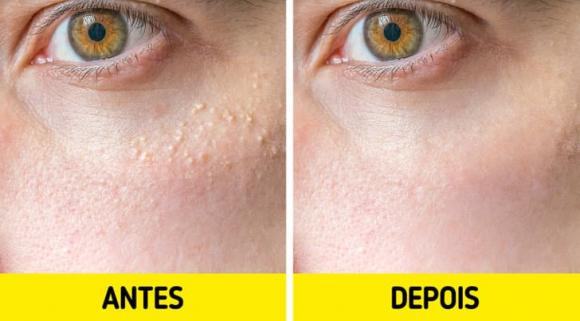 mụn thịt, cách điều trị mụn thịt, làm đẹp da