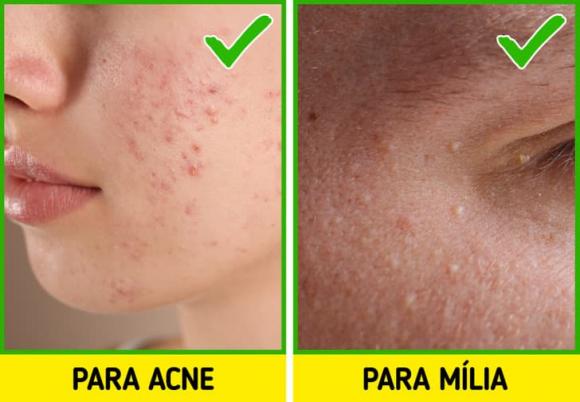 mụn thịt, cách điều trị mụn thịt, làm đẹp da