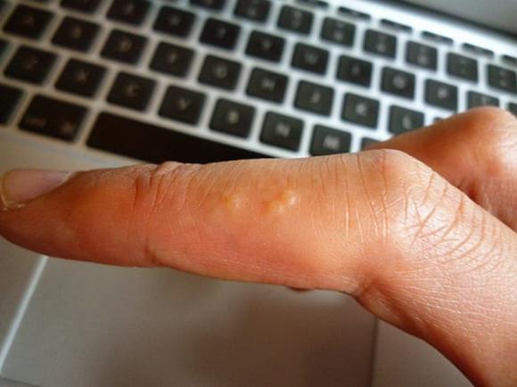 mụn nước, mụn ngứa, nấm, viêm da
