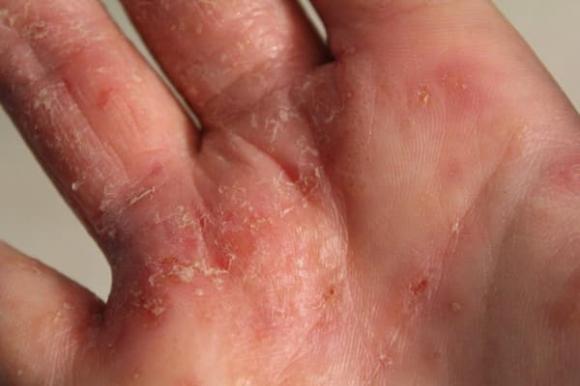 mụn nước, mụn ngứa, nấm, viêm da