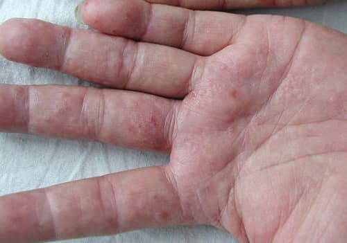 mụn nước, mụn ngứa, nấm, viêm da