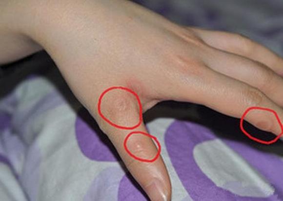 mụn nước, mụn ngứa, nấm, viêm da