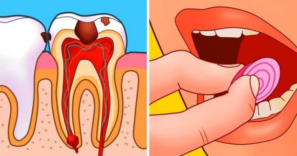 đau răng, cách chữa đau răng, đau răng phải làm sao, sức khỏe 