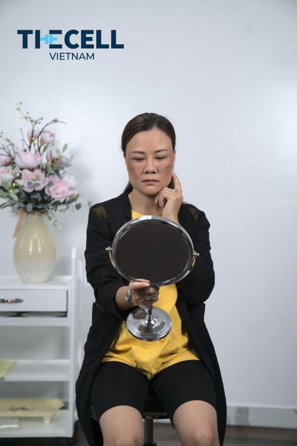nam-va-tan-nhagn.jpg 0 Công nghệ Max Cell, xóa nám và tàn nhang, Phòng khám Thẩm mỹ The Cell Việt Nam