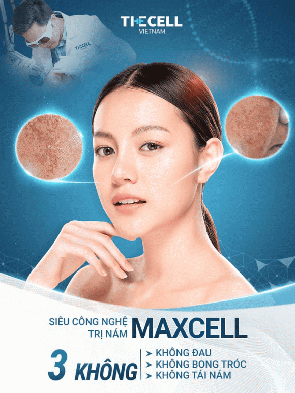 xoa-nam-va-tan-nhang-214 (1).png 0 Công nghệ Max Cell, xóa nám và tàn nhang, Phòng khám Thẩm mỹ The Cell Việt Nam