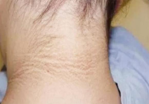 ung thư, bệnh ở cổ, sức khoẻ