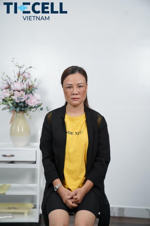 Trị nám Max Cell, nám da, The Cell Việt Nam