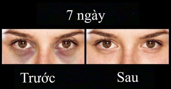 quầng thâm dưới mắt, cách loại bỏ quầng thâm dưới mắt, làm đẹp 
