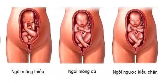 sinh thường, sinh con, trẻ sơ sinh, ngôi thai thuận, ngôi thai ngược
