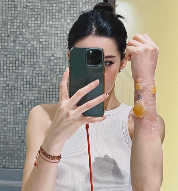 Lưu Đê Ly, Lưu Đê Ly bị bỏng, sao việt 