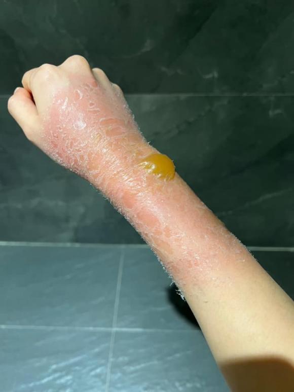 Lưu Đê Ly, Lưu Đê Ly bị bỏng, sao việt 