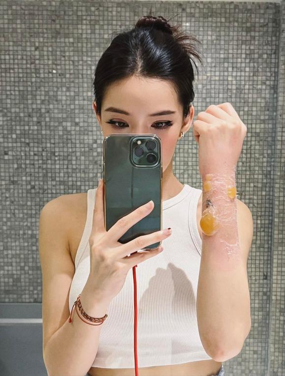 Lưu Đê Ly, Lưu Đê Ly bị bỏng, sao việt 