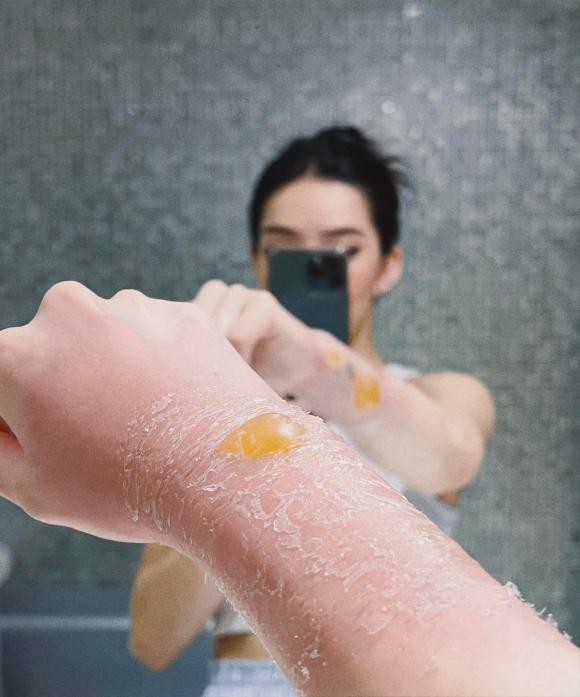 Lưu Đê Ly, Lưu Đê Ly bị bỏng, sao việt 