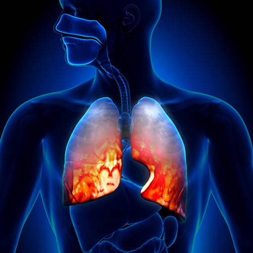 ung thư phổi, ung thư, ung thư phổi chuyển sang giai đoạn cuối