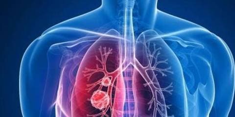 ung thư phổi, ung thư, ung thư phổi chuyển sang giai đoạn cuối