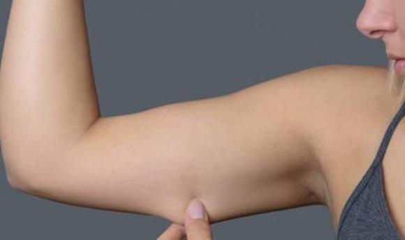 người béo, người mập, giảm béo