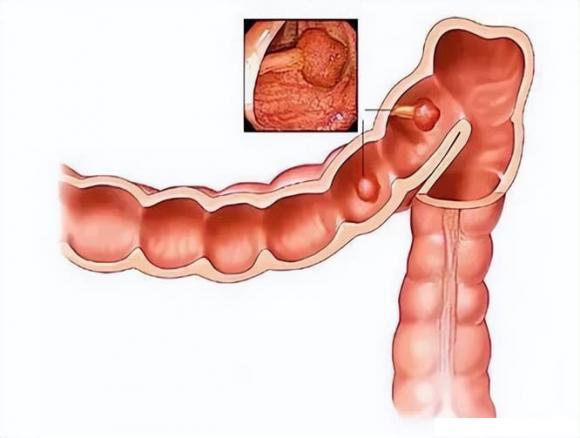  polyp, polyp ruột