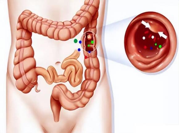  polyp, polyp ruột