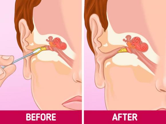 tăm bông, tăm bông ngoáy tai, sức khỏe 