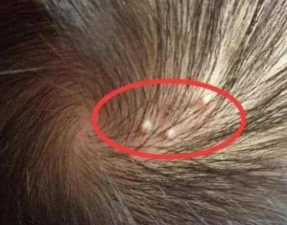Mụn mủ và mụn bọc thường mọc trên da đầu, có vấn đề gì không? Bác sĩ: 'Có thể liên quan 3 bệnh này'