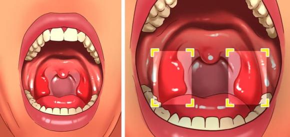 Đá amidan, sỏi amidan, sức khoẻ răng miệng