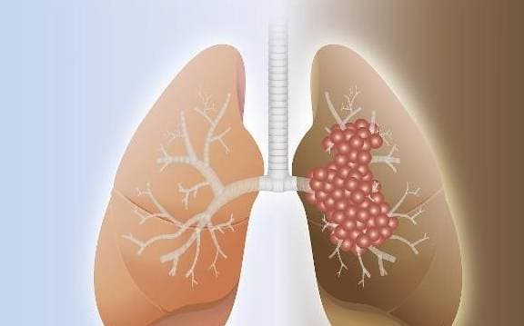 ung thư, ung thư phổi, dấu hiệu ung thư phổi