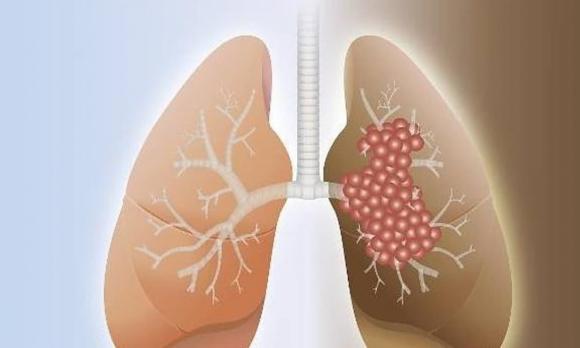 ung thư phổi, bệnh ung thư, dấu hiệu của ung thư phổi
