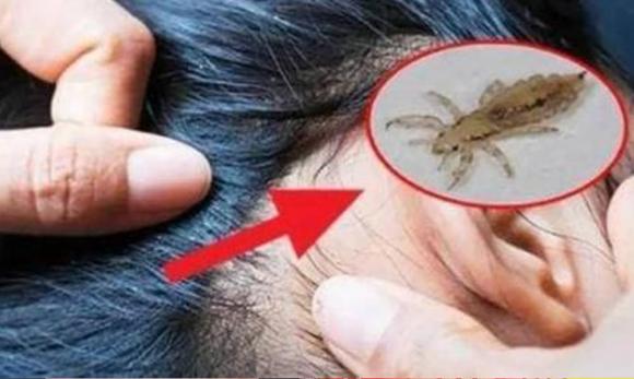 con chấy, chấy ở trên tóc, nguyên nhân bị chấy