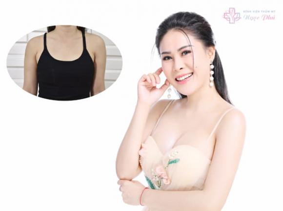 nang-nguc-noi-soi-277 (1).jpg 0 nâng ngực nội soi, Bệnh viện Thẩm mỹ Ngọc Phú, Phẫu thuật thẩm mỹ