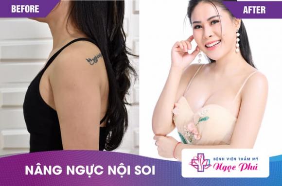 nang-nguc-noi-soi-277 (1).jpg 0 nâng ngực nội soi, Bệnh viện Thẩm mỹ Ngọc Phú, Phẫu thuật thẩm mỹ