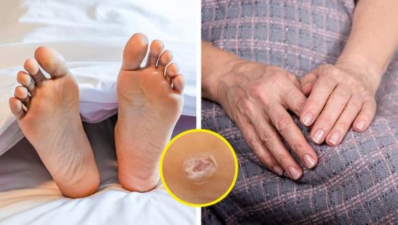nốt ruồi, tại sao nốt ruồi xuất hiện, sức khỏe 