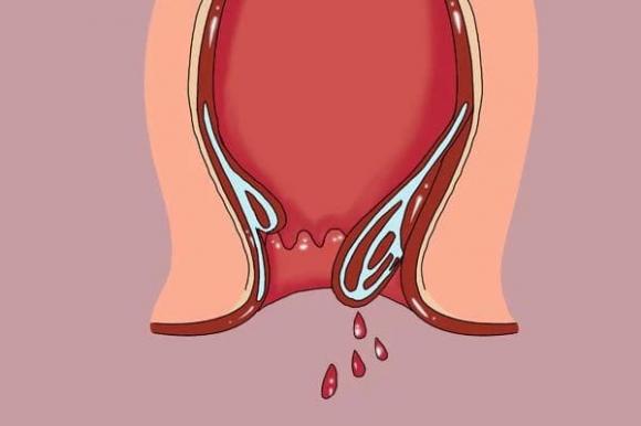 polyp, polyp ruột, đường ruột