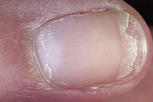 loãng xương, thiếu canxi, bệnh xương khớp