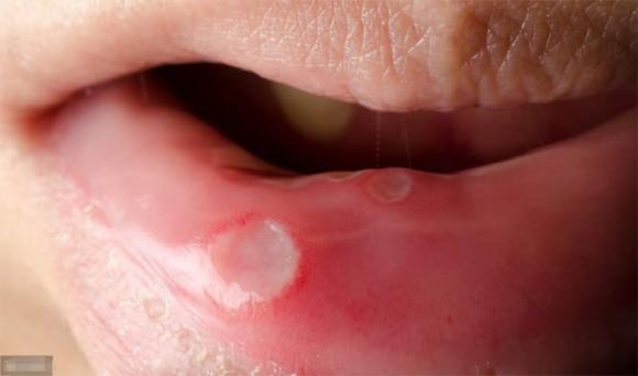 loét miệng, bệnh răng miệng, mùa thu