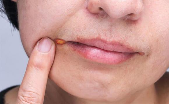 loét miệng, bệnh răng miệng, mùa thu