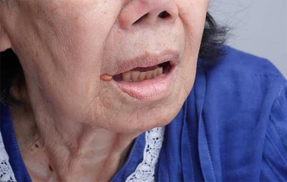 loét miệng, bệnh răng miệng, mùa thu