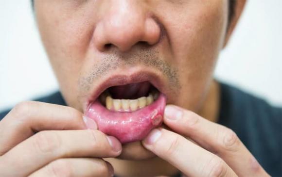 loét miệng, bệnh răng miệng, mùa thu