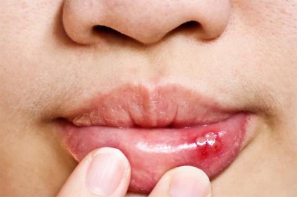 loét miệng, bệnh răng miệng, mùa thu